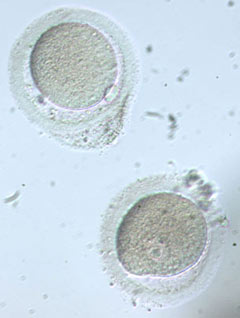 Up: MII oocyte with abnormal zona pelucida and large perivitaline space with debris Down: Immature GV oocyte with large periviteline space.